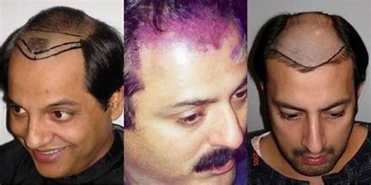 Stories of Celebrity Hair Transplant in Pakistan: Who got it done?
