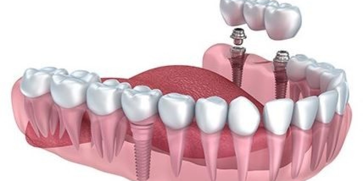 What is the recovery time after having dental implants?