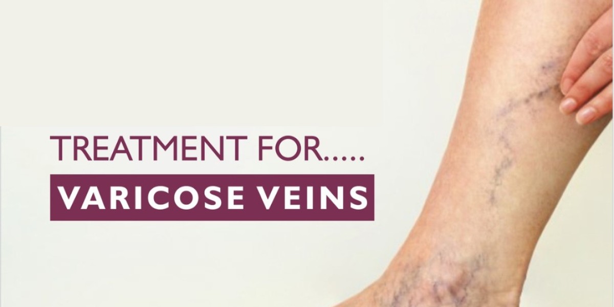 Varicose Veins Treatment: What You Need to Know