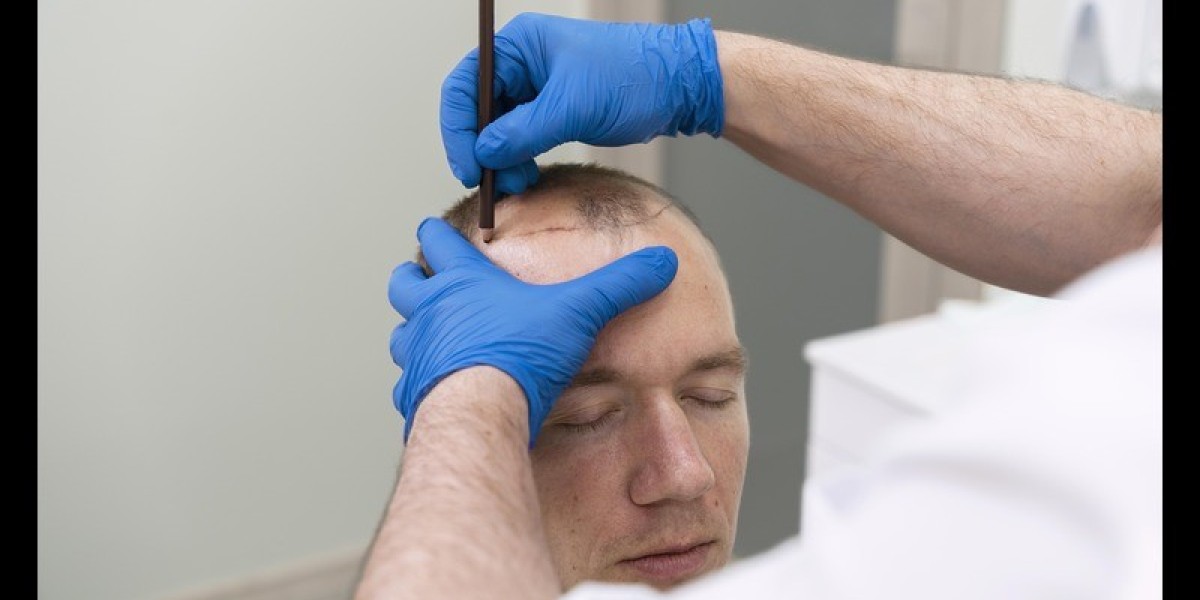 "Unlocking Hair Restoration: The Rise of PRP Treatment in Riyadh"
