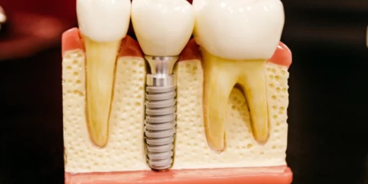 Preserving Smiles with Dental Sealants in Sherman Oaks