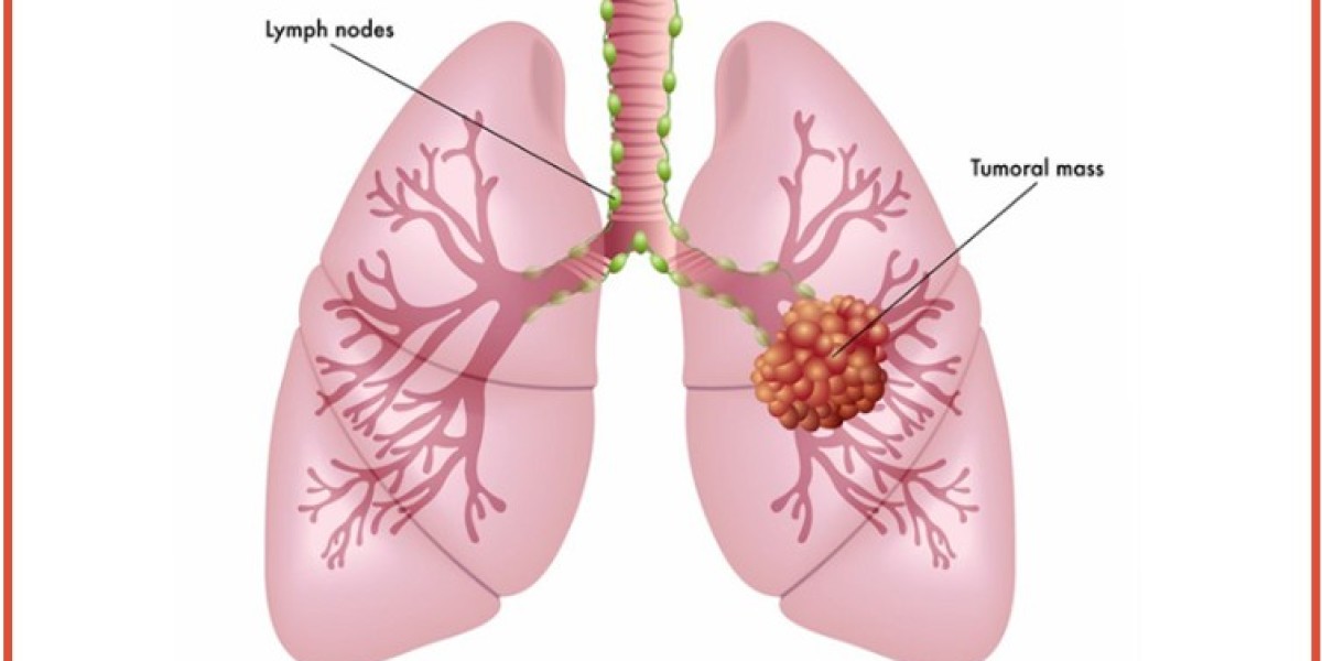 Lung Cancer Treatment in Delhi