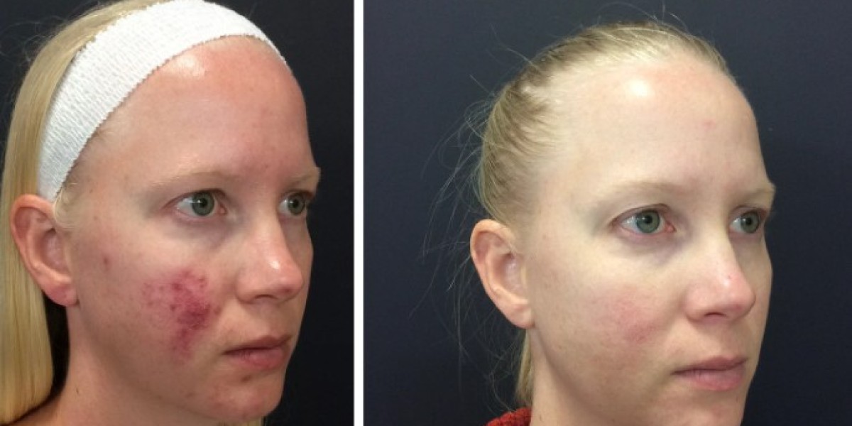 Advanced Acne Scar Treatment in Sheffield