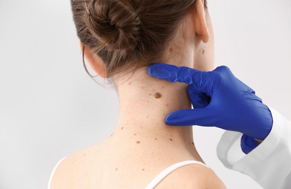 Skin Tag Removal In Barnet: Understanding The Process And Options – Buzz10