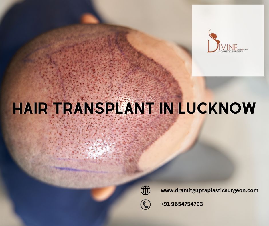 Best Results & Cost of Hair Transplant in Lucknow | TheAmberPost