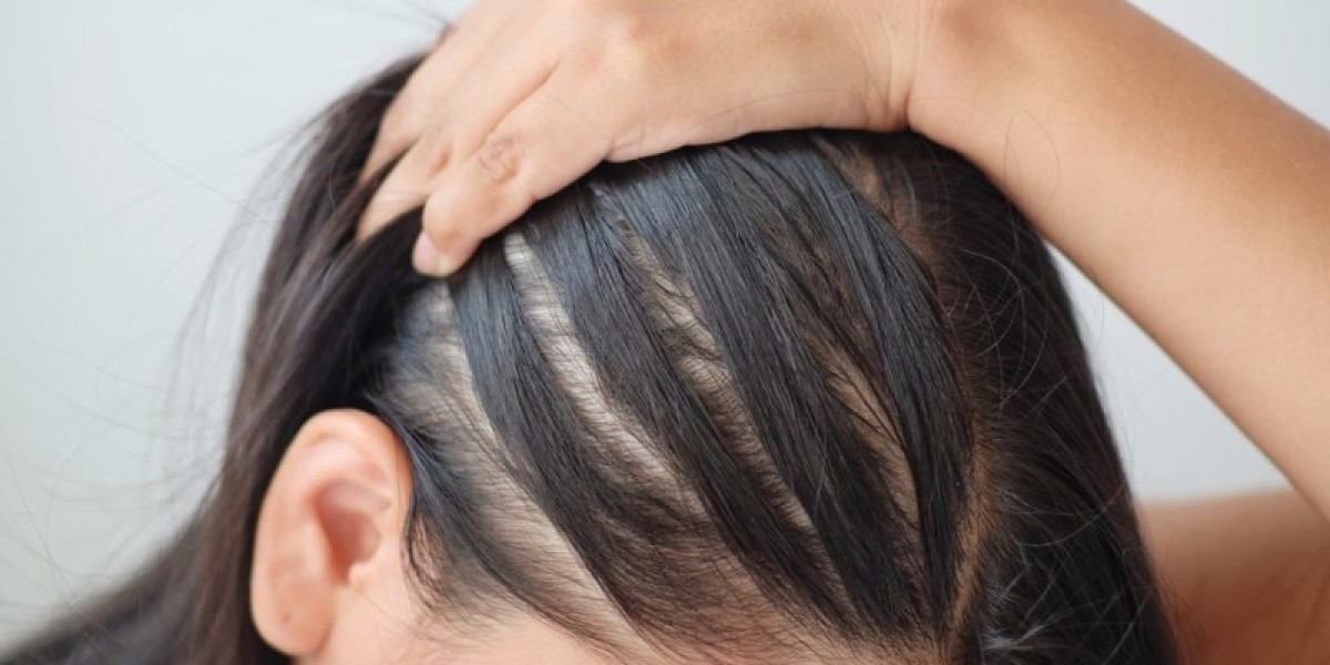 Insights into the Androgenetic Alopecia Market