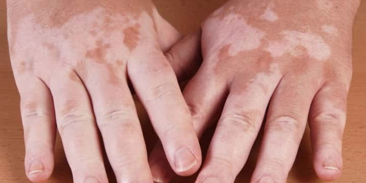 How to Stop Vitiligo From Spreading?