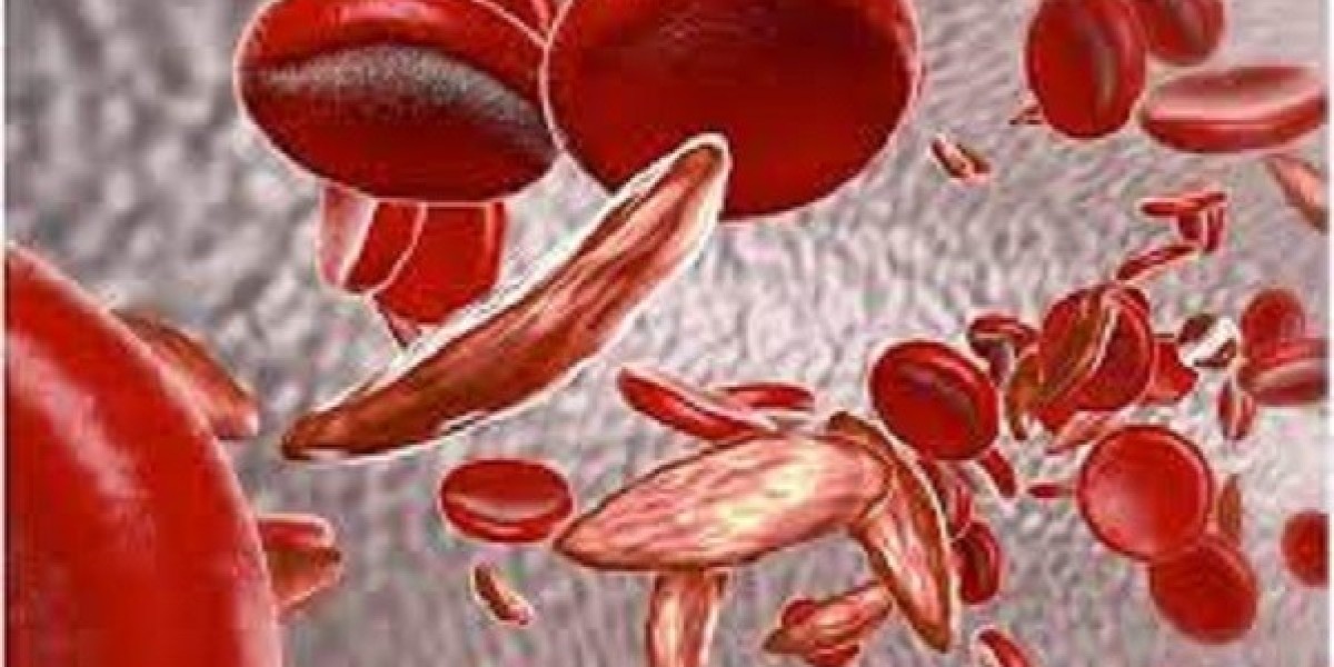 Sickle Cell Disease Market Size 2024: Epidemiology, Industry Trends and Forecast by 2034
