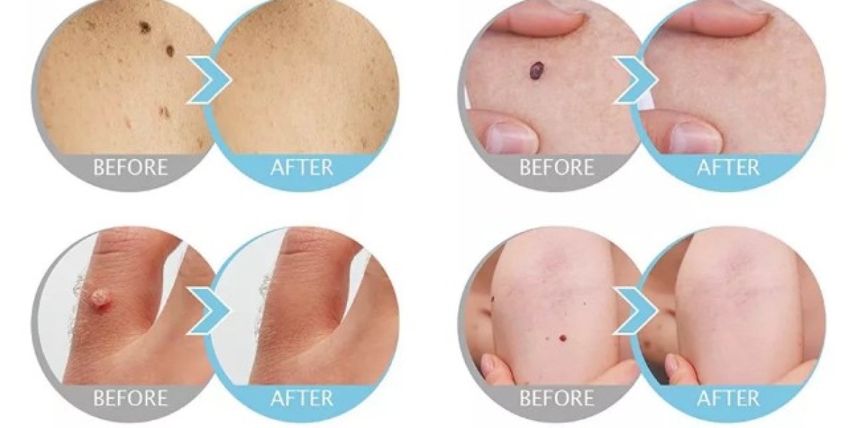 Skin Fix Skin Tag Remover - Mole And Skin Tag Removal Serum!