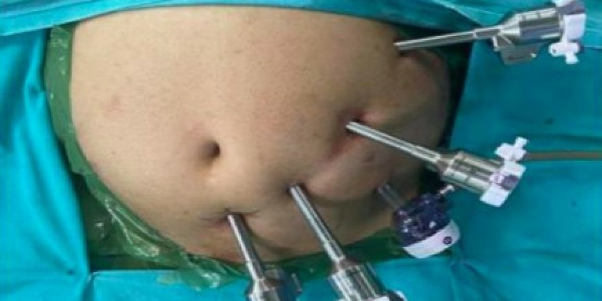 Best Obesity Surgery in Delhi by Dr. Tarun Mittal