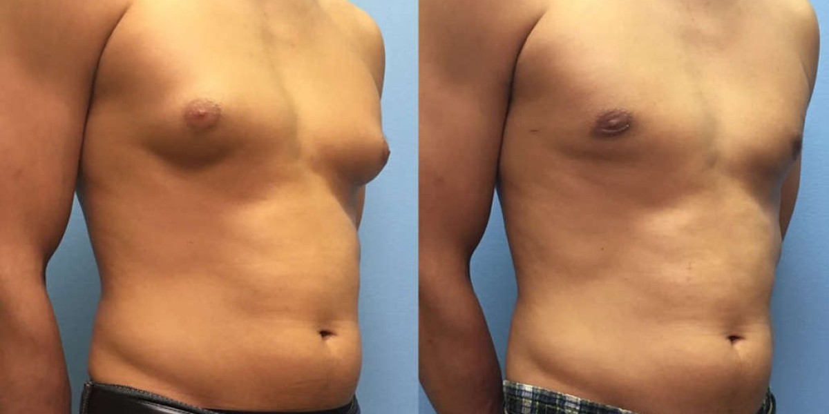 Dr. Shilpy Dolas: An Effective Gynecomastia Treatment in Pune