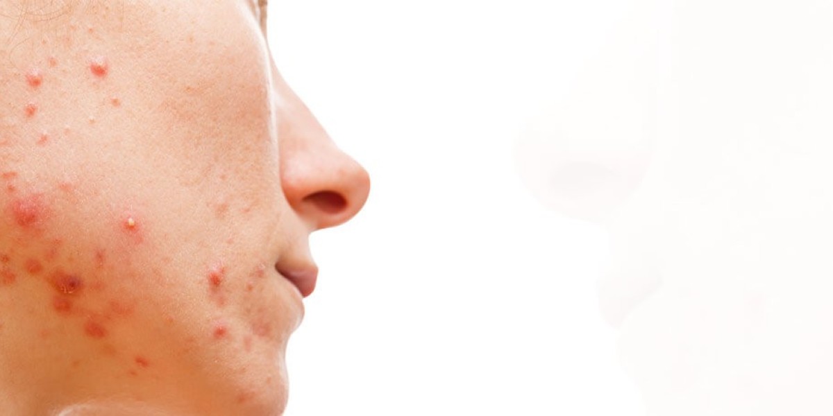 Acne: FAQs and Treatment Options
