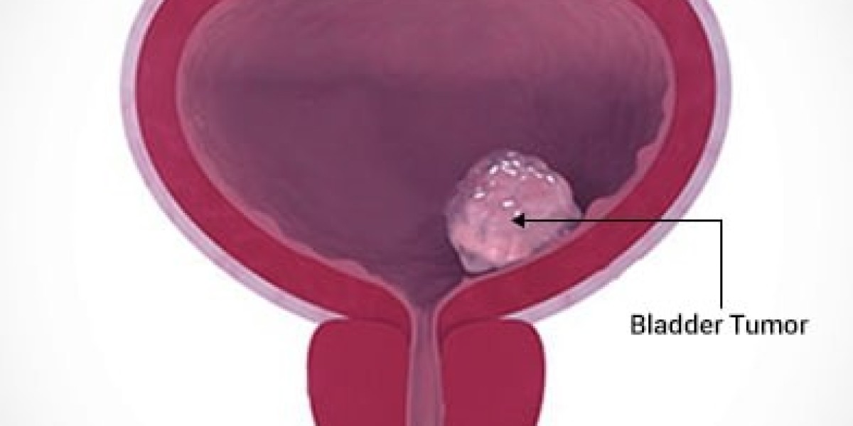 What Increases the Risk of Bladder Cancer?