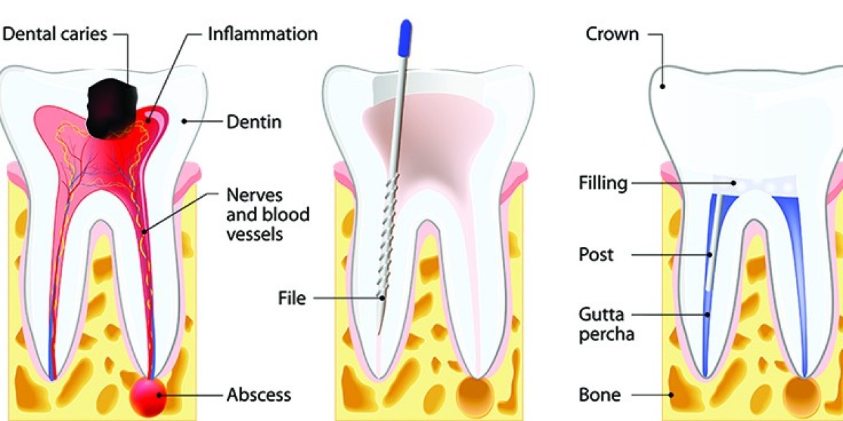Are tooth roots removed during a root canal procedure?