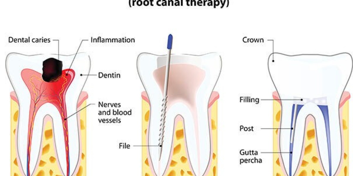 Root Canal Symptoms: 7 Signs and Symptoms You Need To Know