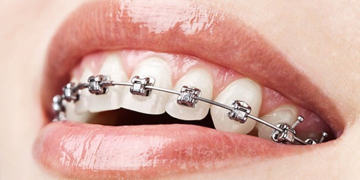 Top 5 Benefits of Teeth Straightening Treatment