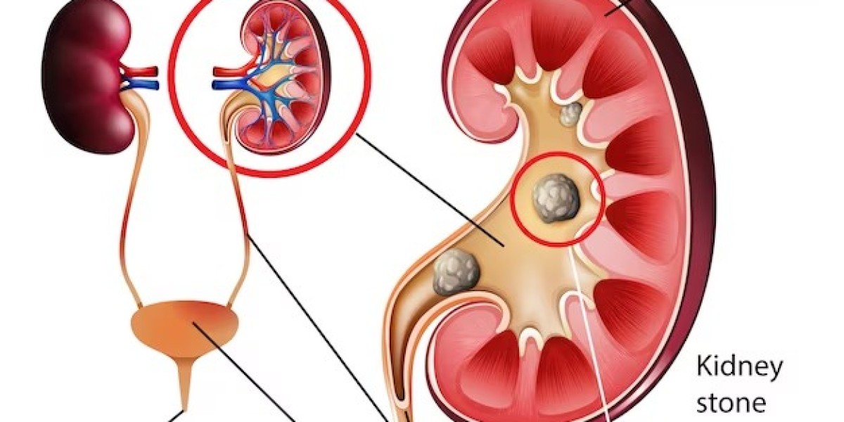 How Much Water Should I Drink If I Have Kidney Stones?