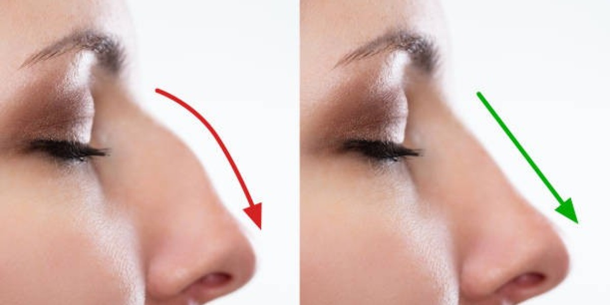 Rhinoplasty in Dubai: A Comprehensive Guide to Nose Reshaping