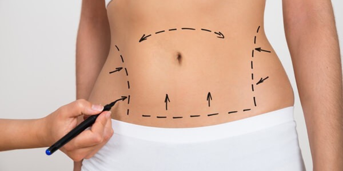 How Much Fat Can Be Removed Through Liposuction?