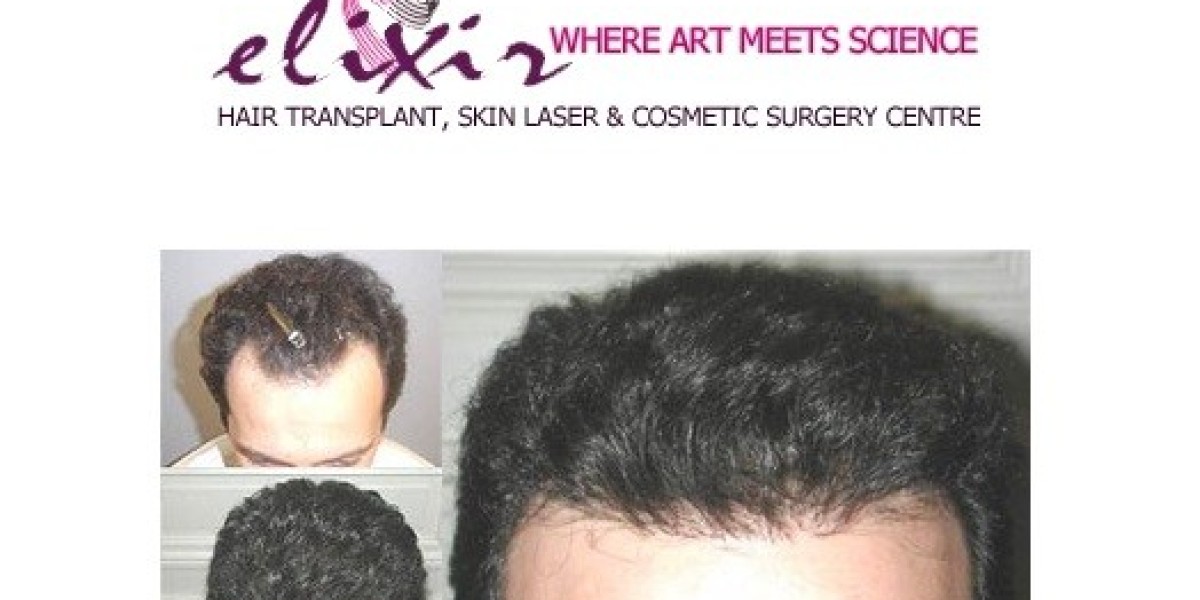 Hair Transplant a New Confidence Booster