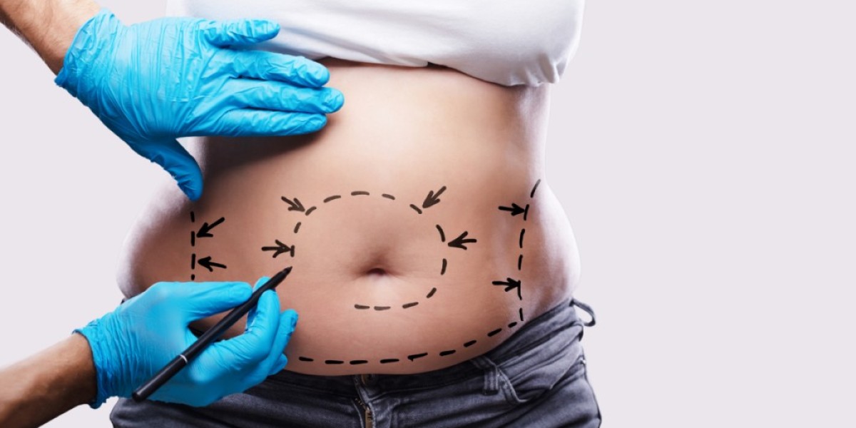 The Ultimate Guide to Liposuction in Dubai: What You Need to Know