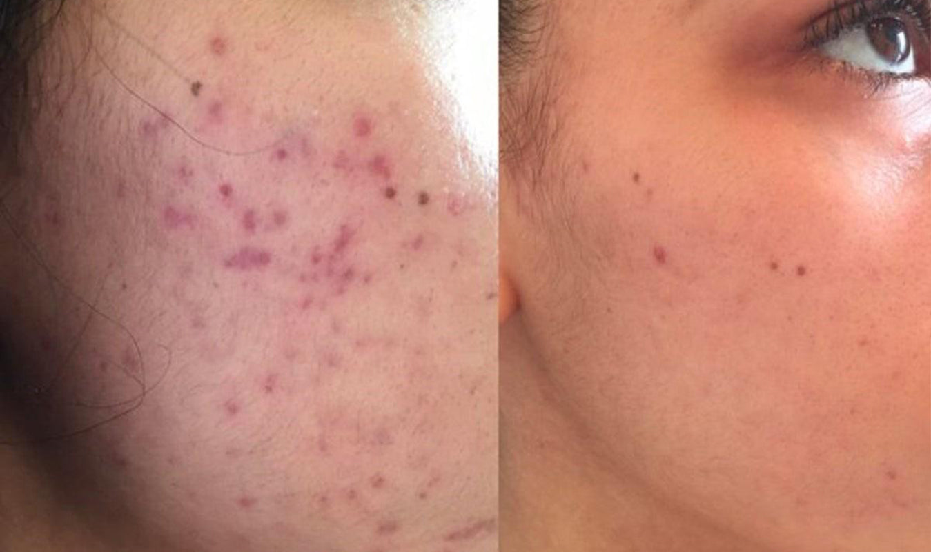 Can face moisturizers help with acne scars?