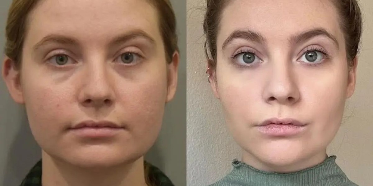How Buccal Fat Removal Can Enhance Your Overall Appearance