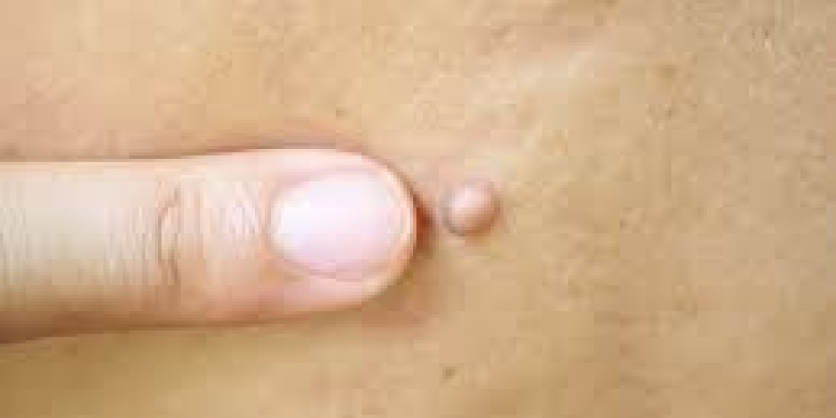 Achieve Clearer Skin: The Best Skin Tag Removal Treatments Available