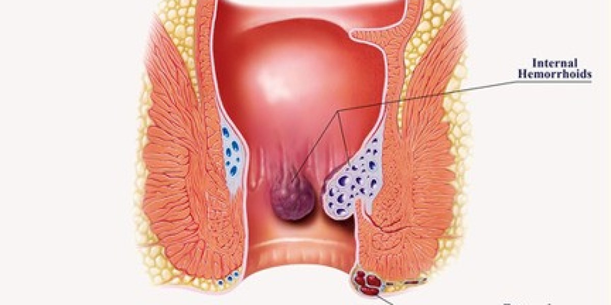 How The Piles Doctor Mumbai Are Revolutionizing Hemorrhoid Treatment