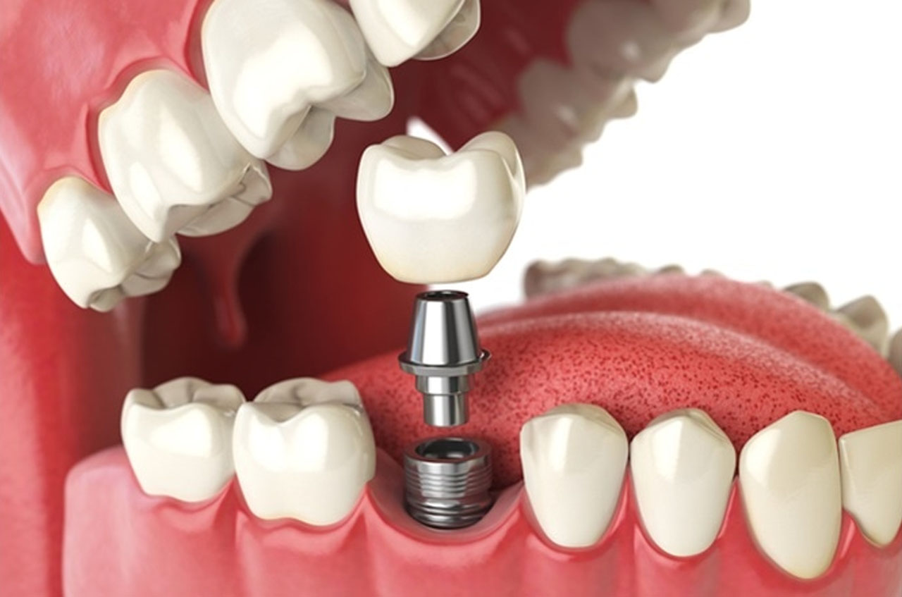 Best Dental Implant In Kolkata | Dental Implants Clinic in Kolkata