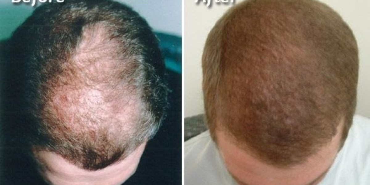 What Are the Best Non-Surgical Hair Restoration Options for Early-Stage Hair Loss?