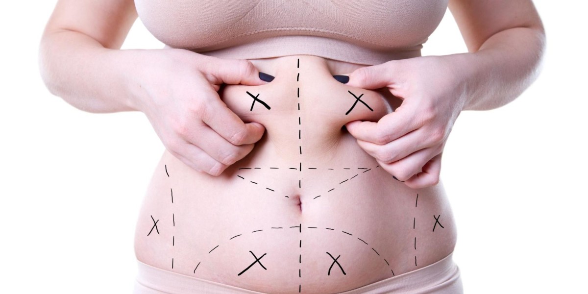 Affordable Liposuction in Riyadh: Exploring the True Costs