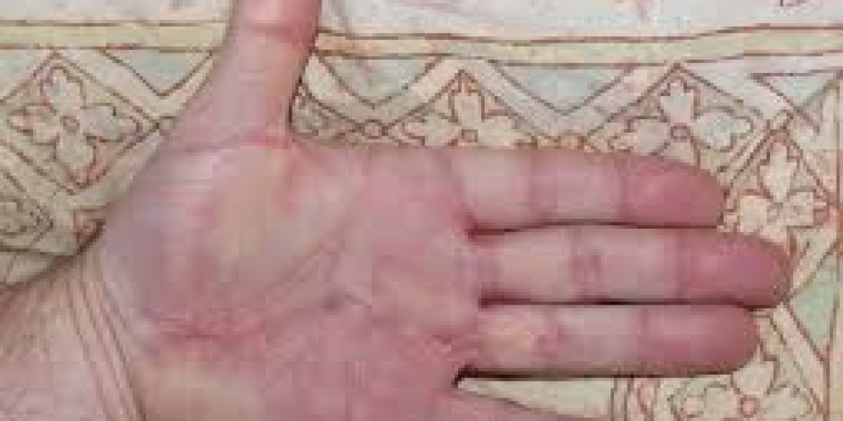 How Is Dupuytren’s Contracture Diagnosed?