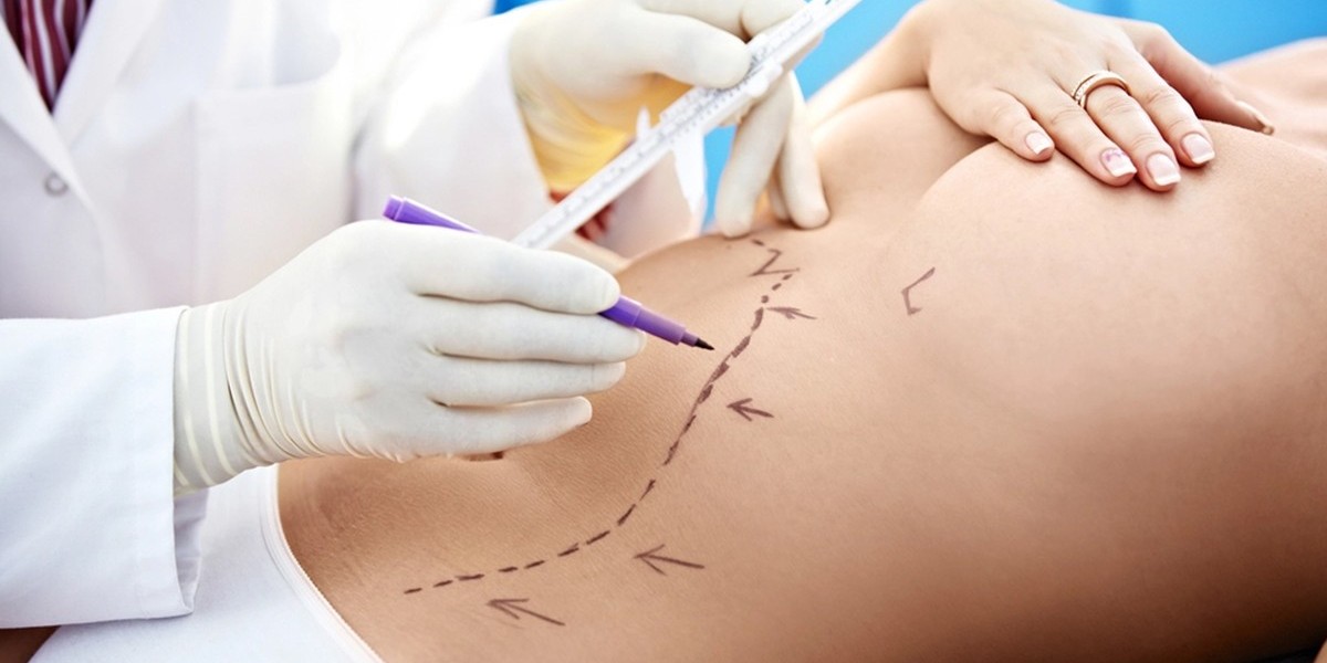 From Consultation to Recovery: Full Breakdown of Liposuction Costs in Riyadh