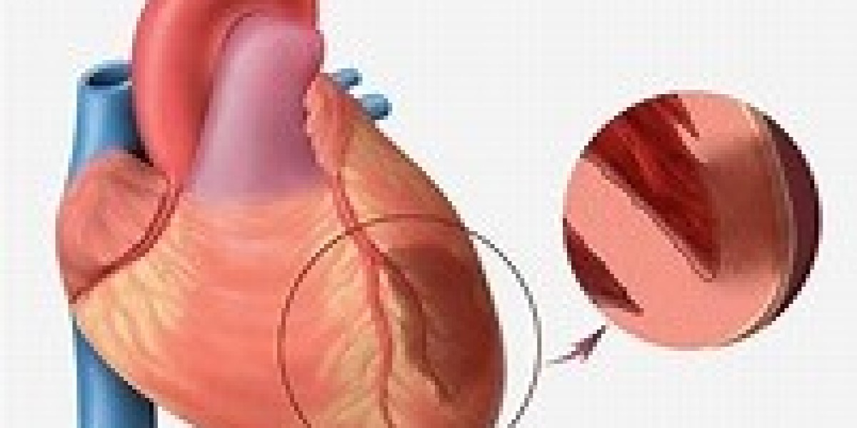 Myocardial Infarction Market  And Forecast : Report 2024-2030