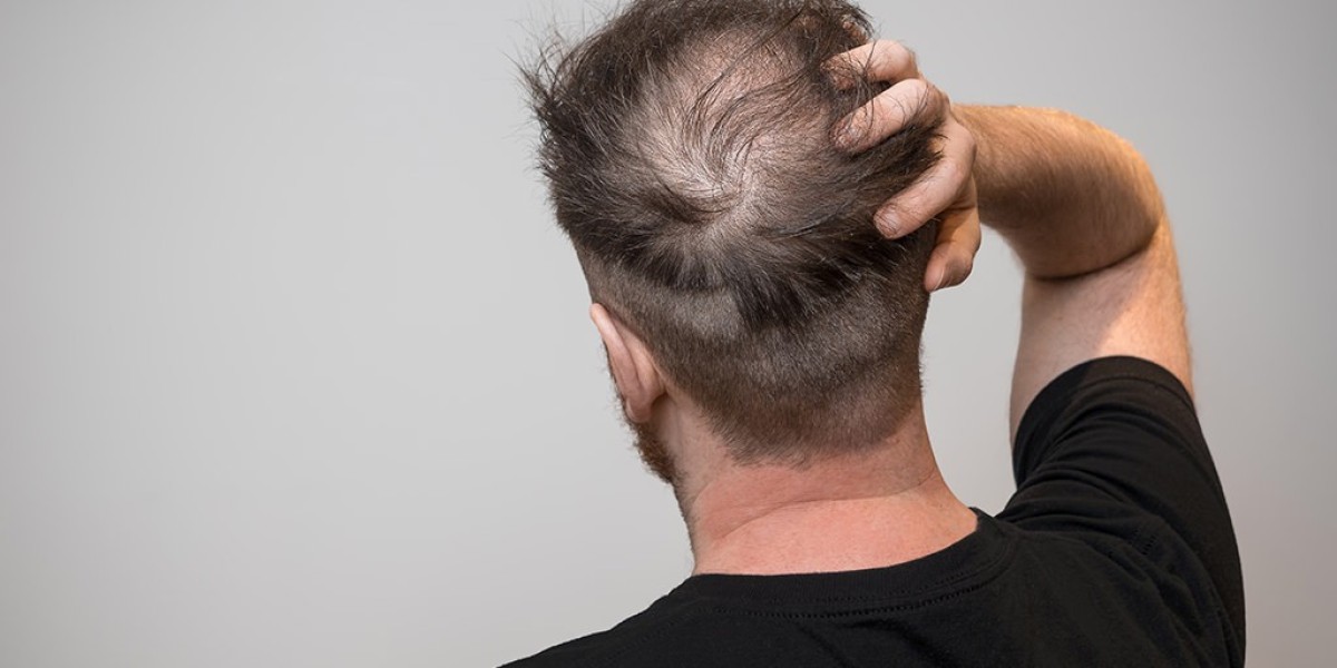 What Patients Should Understand About the Function of AI and Robotics in Hair Transplants