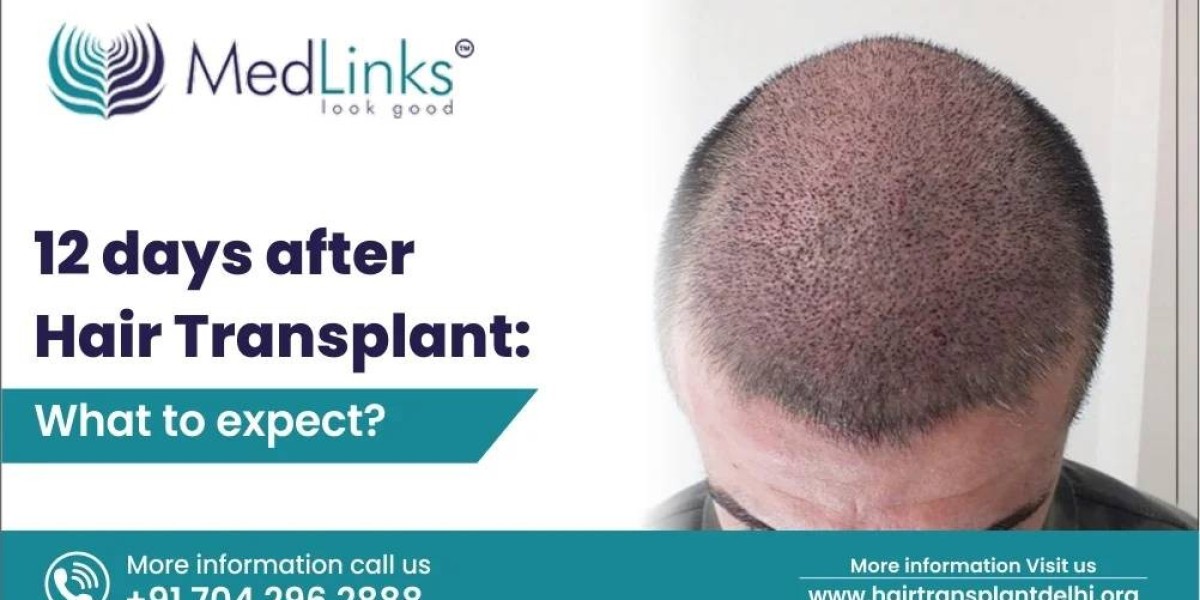 The Road to Recovery: 12 Days After Your Hair Transplant – By HairTransplantDelhi