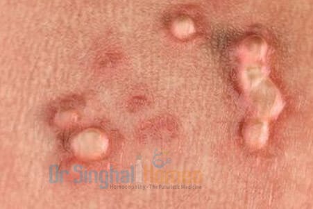 Get the Best Homeopathic Treatment for HPV & Genital Warts