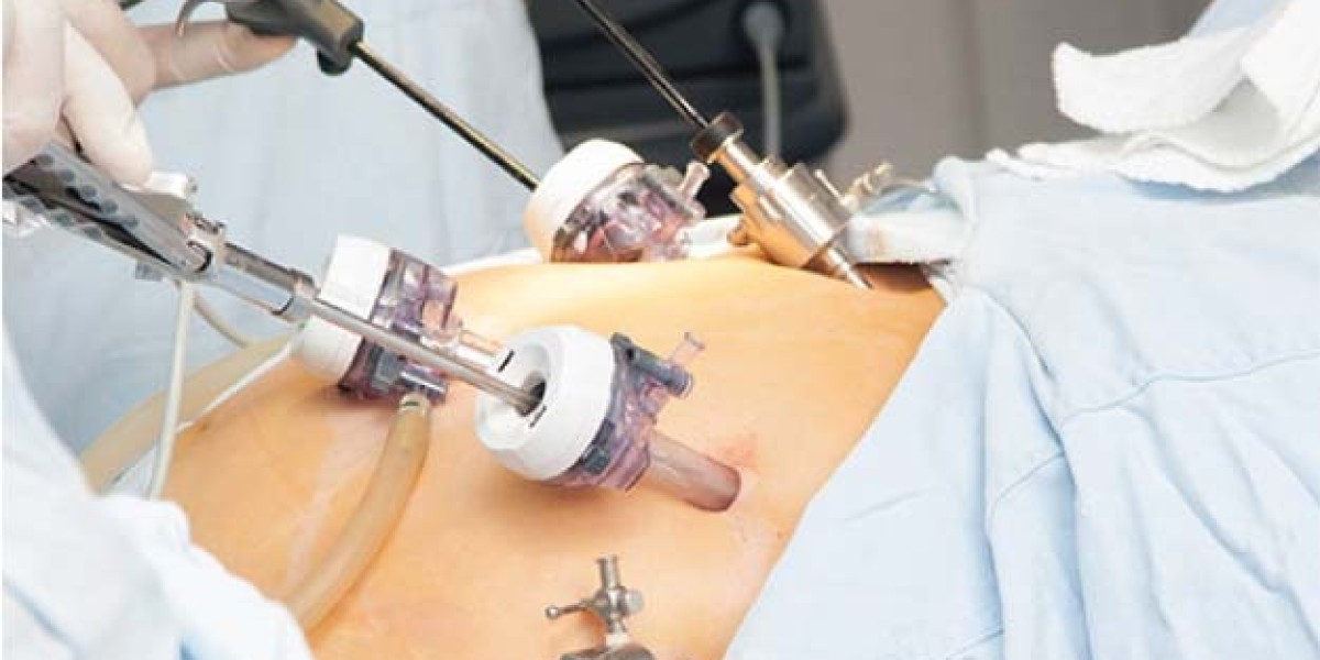 Choosing Laparoscopic Surgery in Riyadh: A Quick Guide