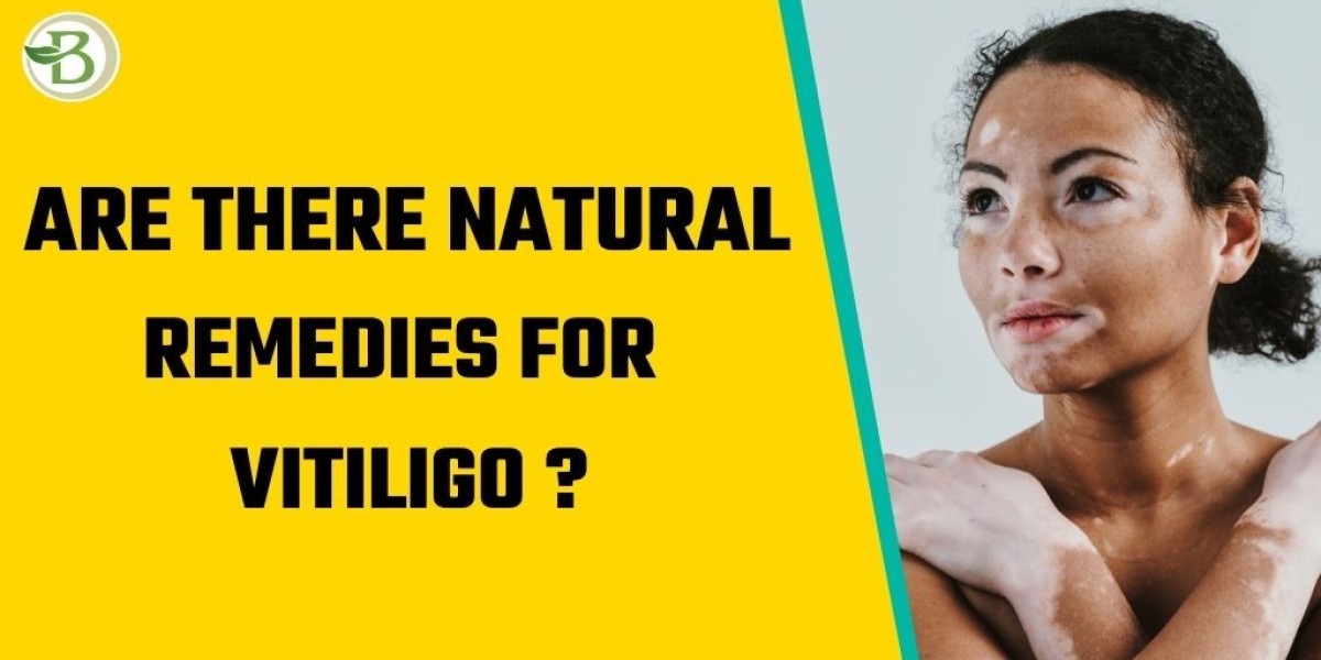 Best Vitiligo Treatments for White Spots on Skin