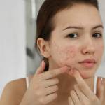 acne scar treatment Profile Picture