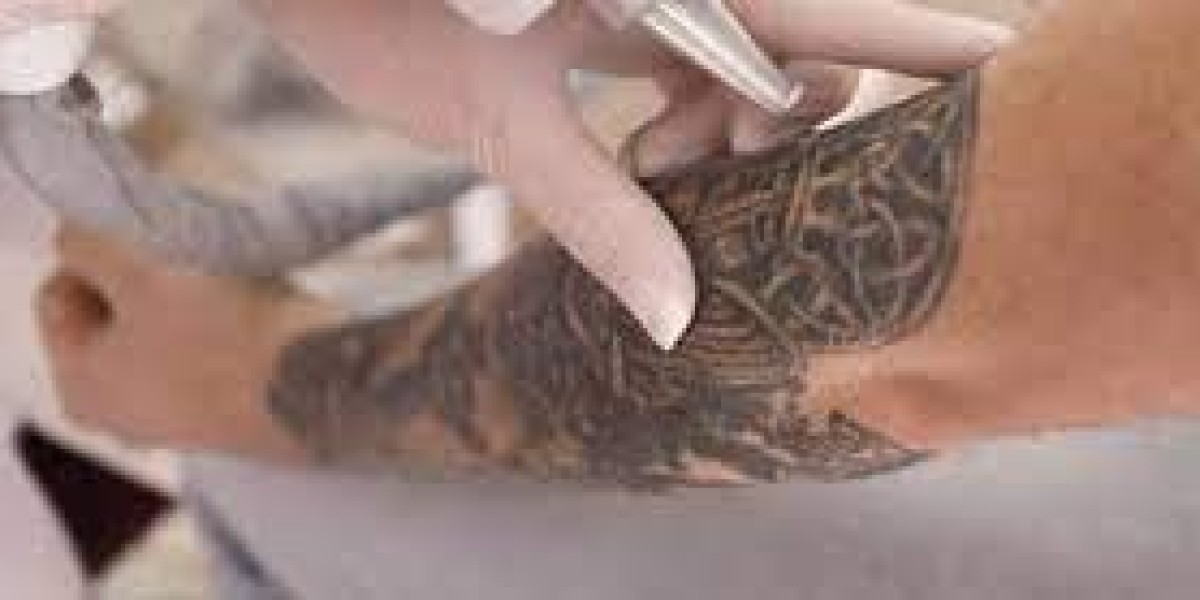 Tattoo Removal in Dubai: Common Myths Debunked