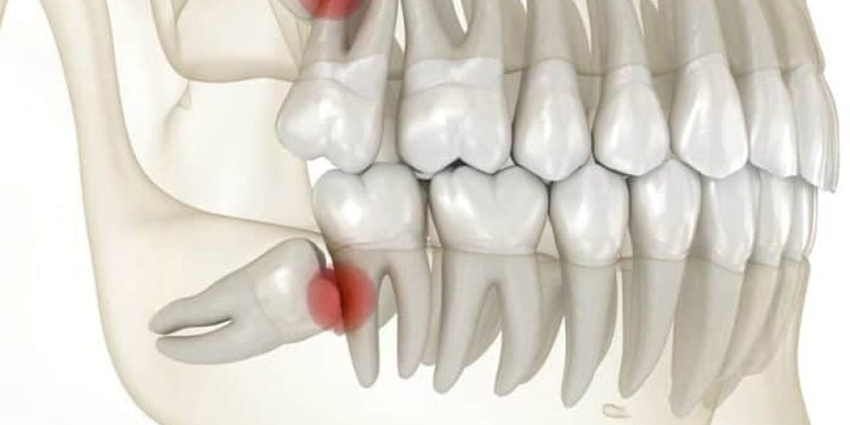 Why do dentists not want to remove wisdom teeth?