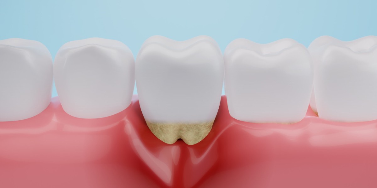 What Happens If You Have Gum Disease for Too Long?