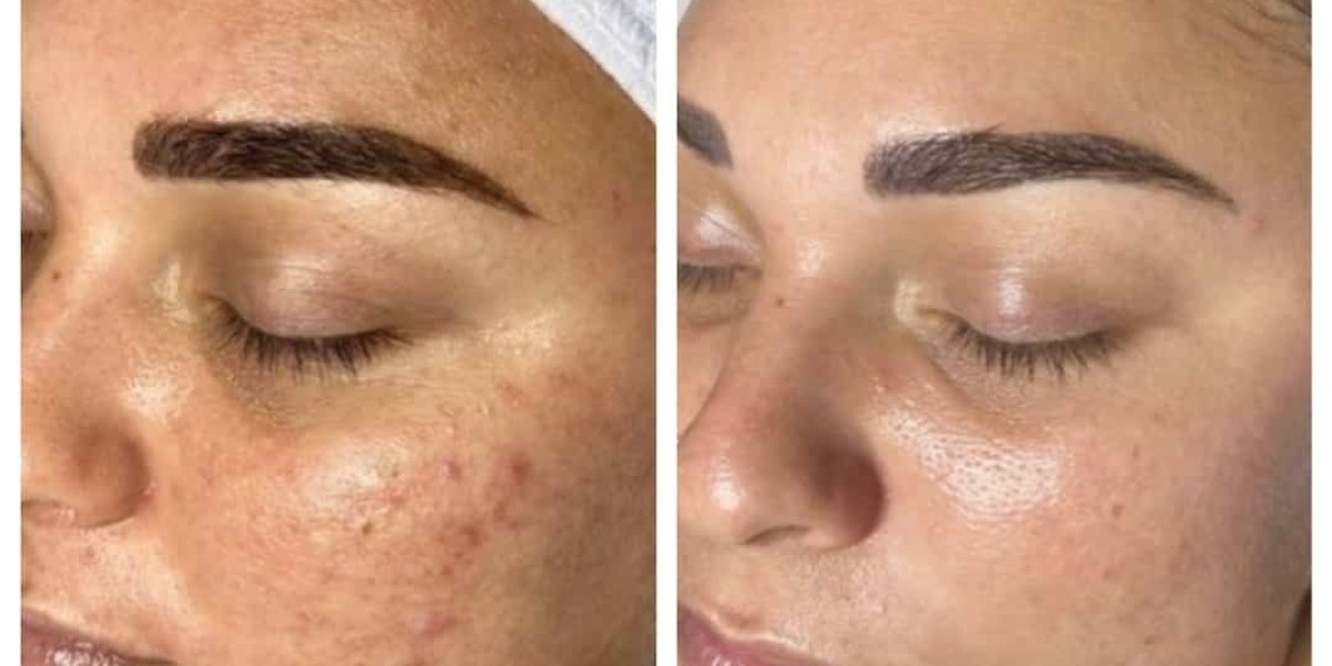 Back-to-School Skincare: HydraFacial Peshawar Offers