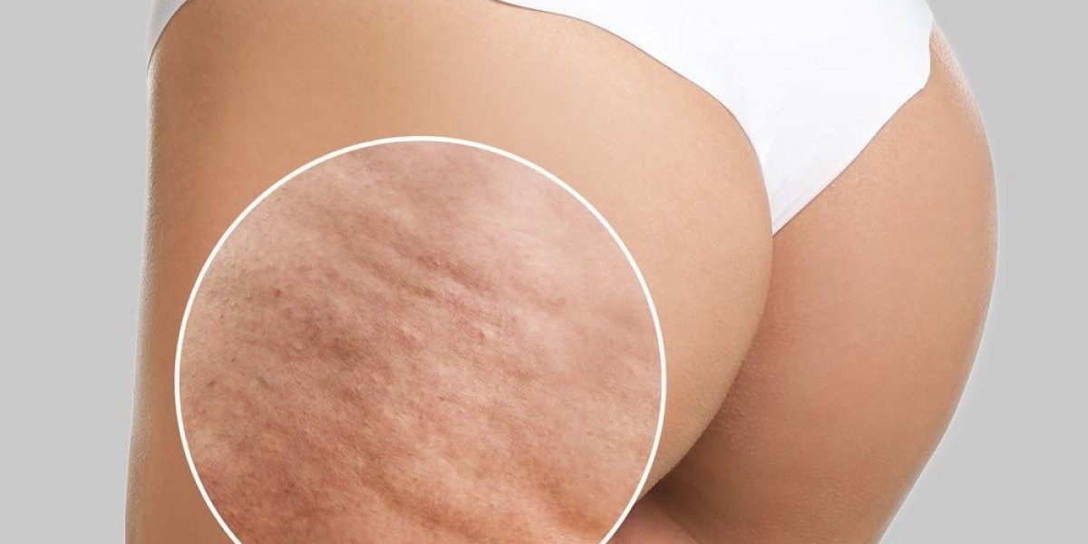 What is the New Technique for Cellulite?