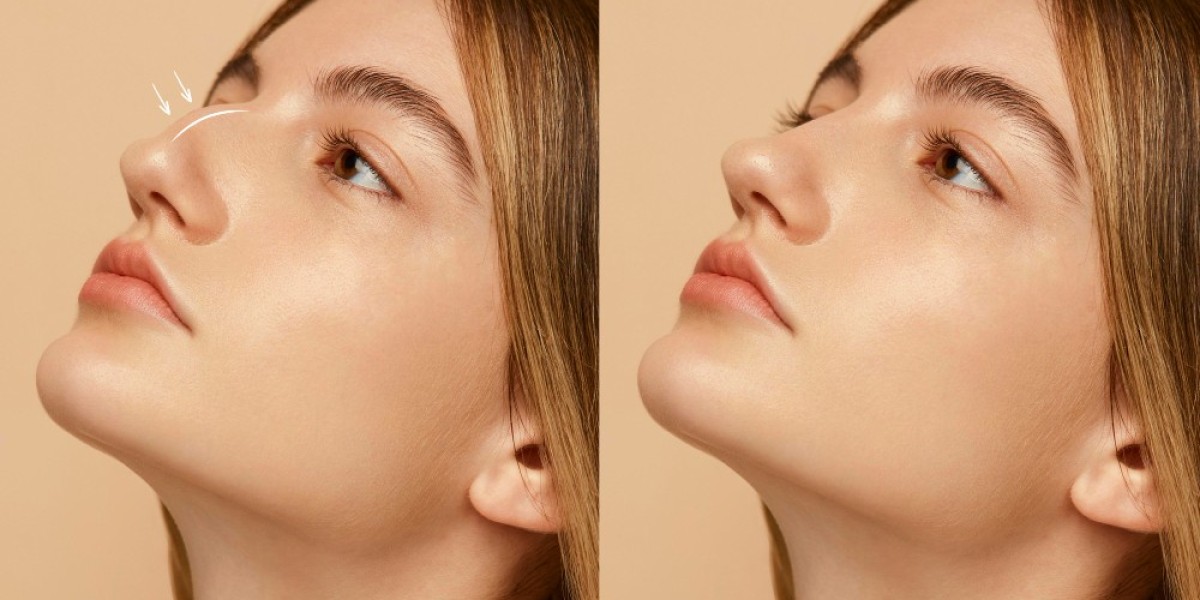 Expert Rhinoplasty Surgeon in Beverly Hills | Natural Rhinoplasty Results