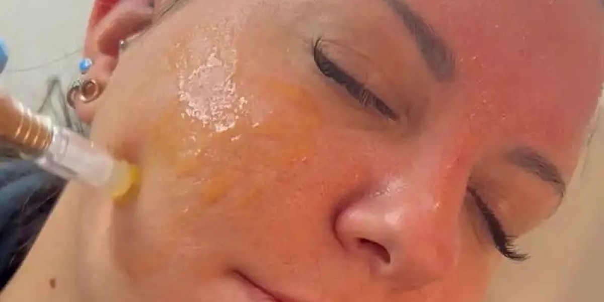 Revitalize Your Skin Naturally with Advanced Exosomes Treatment in Sheffield