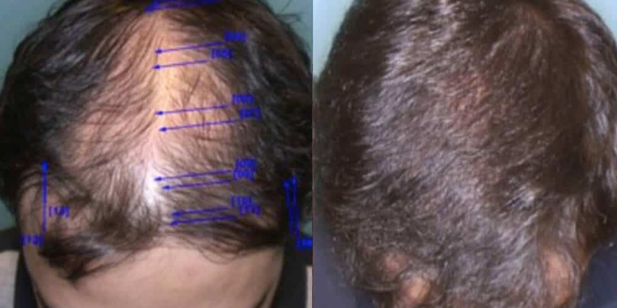 What to Know Before Getting a Hair Transplant in Beverly Hills