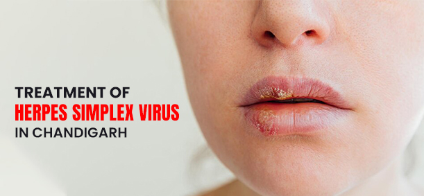 Top Clinics in Chandigarh for Herpes Treatment That Work